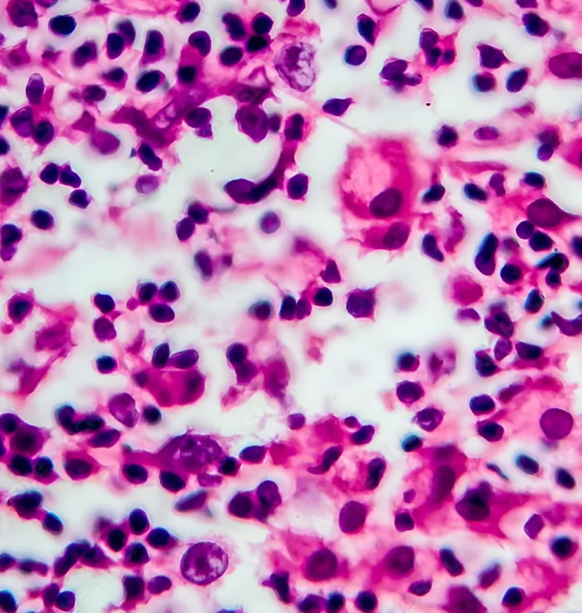 Hodgkin's Lymphoma